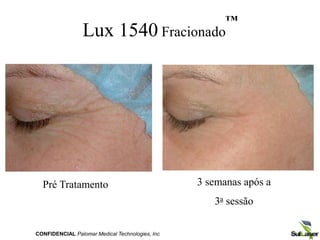 Lux 1540 Fracionado
™
Pré Tratamento 3 semanas após a
3a sessão
CONFIDENCIAL Palomar Medical Technologies, Inc
 
