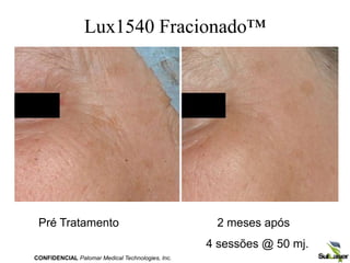 Lux1540 Fracionado™
Pré Tratamento 2 meses após
4 sessões @ 50 mj.
CONFIDENCIAL Palomar Medical Technologies, Inc.
 