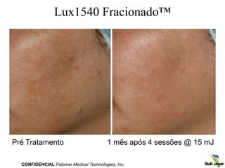 Lux1540 Fracionado™
Pré Tratamento 1 mês após 4 sessões @ 15 mJ
CONFIDENCIAL Palomar Medical Technologies, Inc.
 
