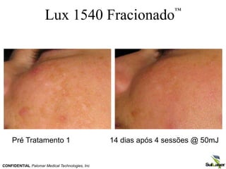 Lux 1540 Fracionado™
CONFIDENTIAL Palomar Medical Technologies, Inc
Pré Tratamento 1 14 dias após 4 sessões @ 50mJ
 