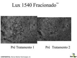 Lux 1540 Fracionado™
Pré Tratamento 1 Pré Tratamento 2
CONFIDENTIAL Palomar Medical Technologies, Inc
 