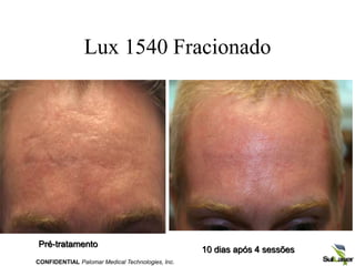 Lux 1540 Fracionado
10 dias após 4 sessões
Pré-tratamento
CONFIDENTIAL Palomar Medical Technologies, Inc.
 