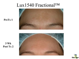 Lux1540 Fractional™
PreTx 1
3 Wk
Post Tx 2
 
