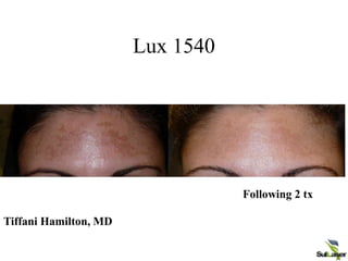 Lux 1540
Following 2 tx
Tiffani Hamilton, MD
 