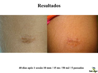 Resultados
40 dias após 1 sessão 10 mm / 15 ms / 50 mJ / 5 passadas
 