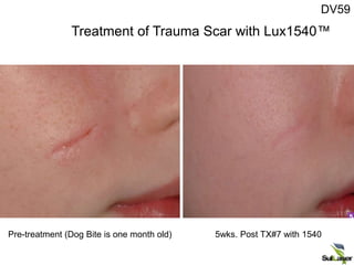 Pre-treatment (Dog Bite is one month old) 5wks. Post TX#7 with 1540
DV59
Treatment of Trauma Scar with Lux1540™
 