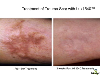 Treatment of Trauma Scar with Lux1540™
Pre 1540 Treatment 3 weeks Post #6 1540 Treatments
 