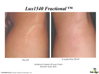 6 weeks Post TX #2
Pre-TX
Aesthetica Cosmetic & Laser Center
David B. Vasily, M.D.
Lux1540 Fractional ™
CONFIDENTIAL Palomar Medical Technologies, Inc.
 