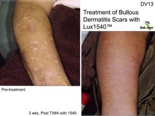 Pre-treatment
3 wks. Post TX#4 with 1540
DV13
Treatment of Bullous
Dermatitis Scars with
Lux1540™
 