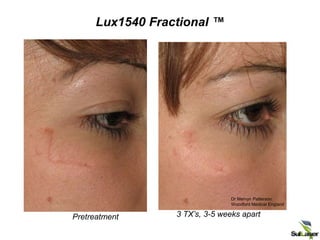 Dr Mervyn Patterson
Woodford Medical England
Lux1540 Fractional ™
3 TX’s, 3-5 weeks apart
Pretreatment
 