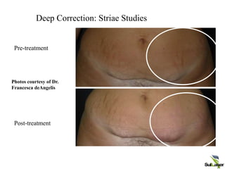 CONFIDENTIAL | ©
2008 Palomar Medical
Photos courtesy of Dr.
Francesca deAngelis
Deep Correction: Striae Studies
Pre-treatment
Post-treatment
 