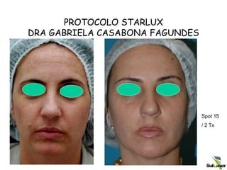 PROTOCOLO STARLUX
DRA GABRIELA CASABONA FAGUNDES
Spot 15
/ 2 Tx
 