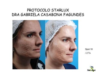 PROTOCOLO STARLUX
DRA GABRIELA CASABONA FAGUNDES
Spot 10
/ 2 Tx
 