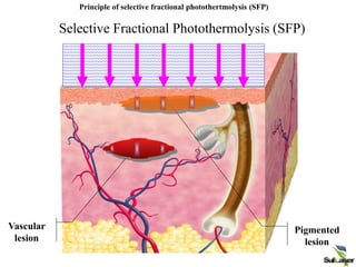 Selective Fractional Photothermolysis (SFP)
Principle of selective fractional photothertmolysis (SFP)
Pigmented
lesion
Vascular
lesion
 