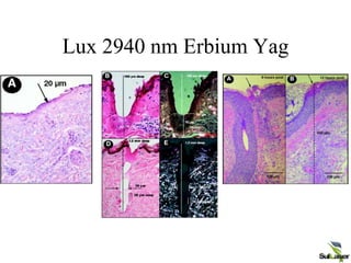 Lux 2940 nm Erbium Yag
 