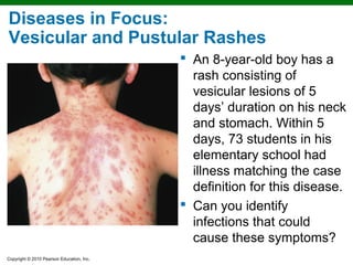Microbial Diseases of the Skin and Eyes | PPT