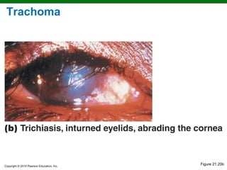 Trachom Microbial Diseases of the Skin and Eyes | PPT