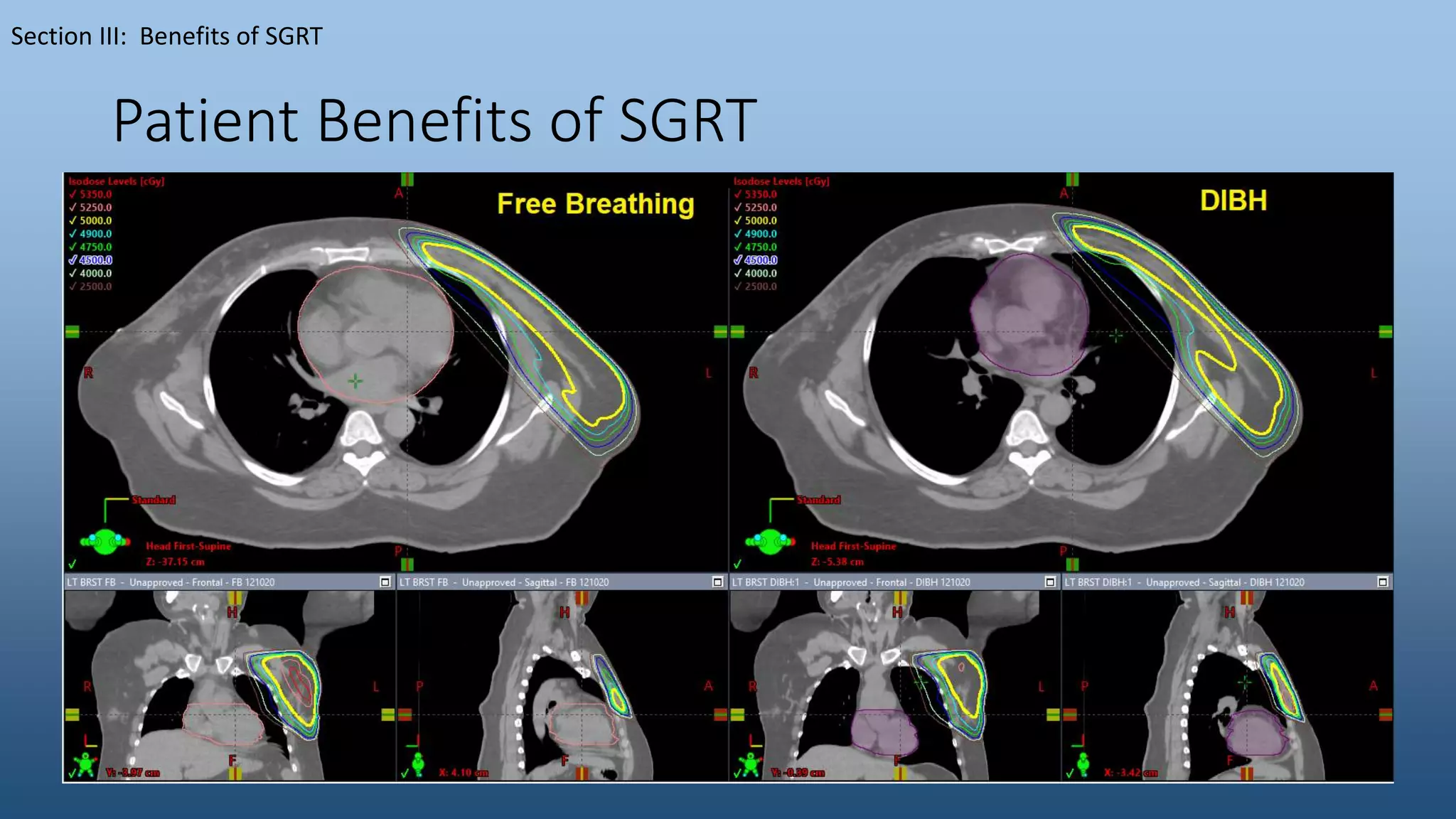 Patient Benefits of SGRT
Section III: Benefits of SGRT
 