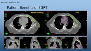 Patient Benefits of SGRT
Section III: Benefits of SGRT
 