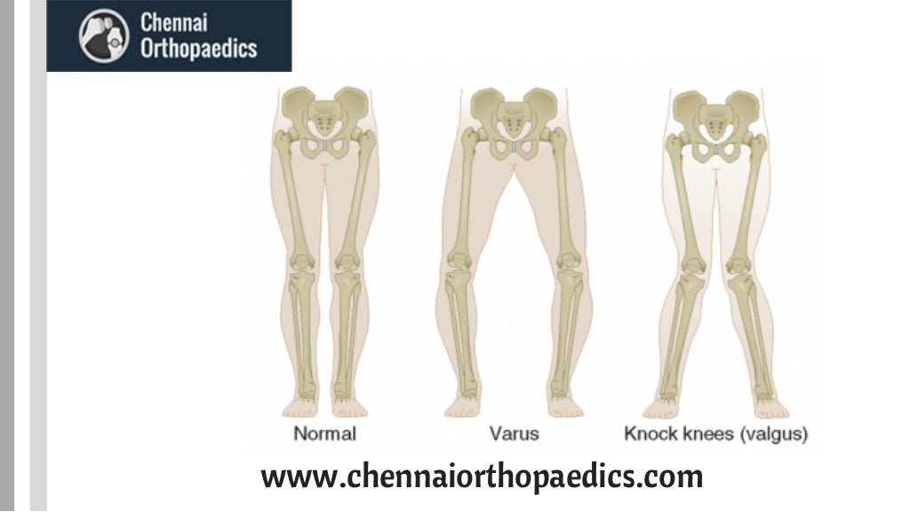 Knee Deformity Correction In Chennai Orthopedic Surgeon In India