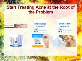 Start Treating Acne at the Root of
the Problem

 