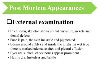 • In children, skeleton shows spinal curvature, rickets and
dental defects
• Face is pale, the skin inelastic and pigmented
• Edema around ankles and inside the thighs, in wet type
there is marked edema, ascites and pleural effusion
• Eyes are sunken, cheek bones appear prominent
• Hair is dry, lusterless and brittle
Post Mortem Appearances
External examination
 
