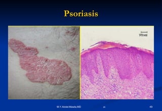 Psoriasis 
