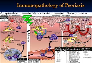 Immunopathology of Psoriasis 