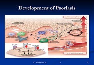 Development of Psoriasis 