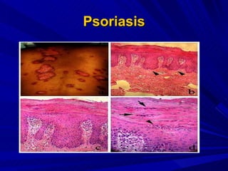 Psoriasis 