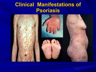 Clinical  Manifestations of Psoriasis 