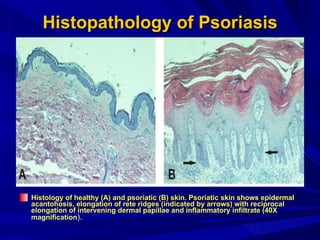 Histopathology of Psoriasis Histology of healthy (A) and psoriatic (B) skin. Psoriatic skin shows epidermal acantohosis, elongation of rete ridges (indicated by arrows) with reciprocal elongation of intervening dermal papillae and inflammatory infiltrate (40X magnification ).  