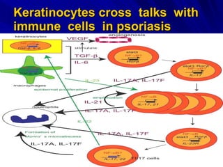 Keratinocytes cross  talks  with immune  cells   in psoriasis 