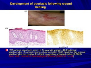 Development of psoriasis following wound healing . ( A)Psoriasis upon burn scar in a 74-year-old woman. (B) Epidermal keratinocytes of psoriatic lesions show activated Stat3. Nuclei of the lesional keratinocytes are positive for Stat3, suggesting activated status of Stat3 )  Sano   etal., Journal of Dermatological Science (2008) 50, 1—14 ) 