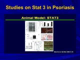 Studies on Stat 3 in Psoriasis 