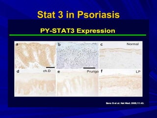 Stat 3 in Psoriasis 