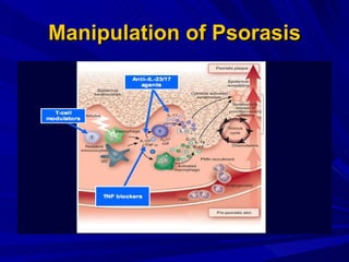 Manipulation of Psorasis 