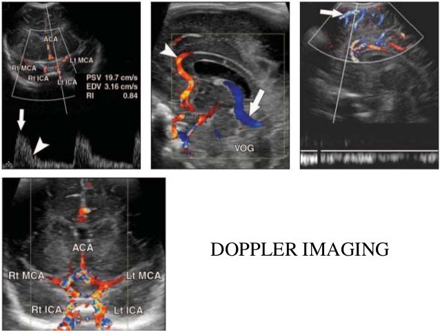 ct doppler