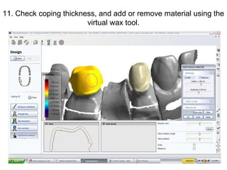 11. Check coping thickness, and add or remove material using the
virtual wax tool.
 