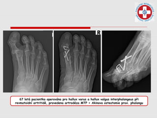 67 letá pacientka operována pro hallux varus a hallux valgus interphalangeus při
revmatoidní artritidě, provedena artrodéza MTP + Akinova osteotomie prox. phalangu
 