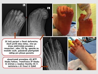 32 letý pacient s flexní deformitou
všech prstů obou nohou, stav po
úrazu elektrickým proudem s
resuscitací, váha 132 kg, upoután na
invalidní vozík, požadován plantigrádní
nášlap pro přesun pacienta
oboustranně provedena AD MTP
kloubu halluxu, transfixace IP kloubu
Ki drátem a resekce hlavičky II-V.
metatarzu s Ki fixací 6 týdnů
 