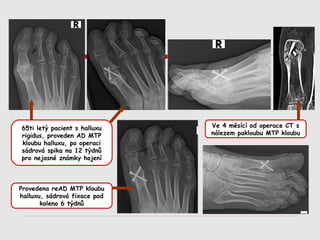 65ti letý pacient s halluxu
rigidus, proveden AD MTP
kloubu halluxu, po operaci
sádrová spika na 12 týdnů
pro nejasné známky hojení
Ve 4 měsící od operace CT s
nálezem pakloubu MTP kloubu
Provedena reAD MTP kloubu
halluxu, sádrová fixace pod
koleno 6 týdnů
 
