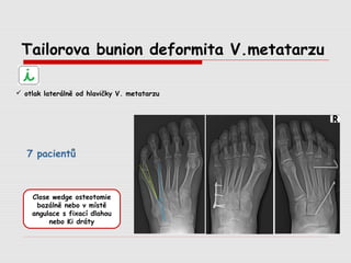 Tailorova bunion deformita V.metatarzu
 otlak laterálně od hlavičky V. metatarzu
7 pacientů
Close wedge osteotomie
bazálně nebo v místě
angulace s fixací dlahou
nebo Ki dráty
 