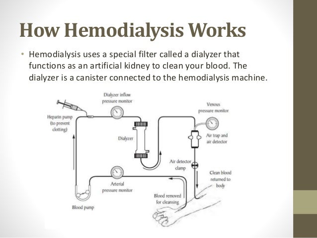stationary treatment how hemodialysis works