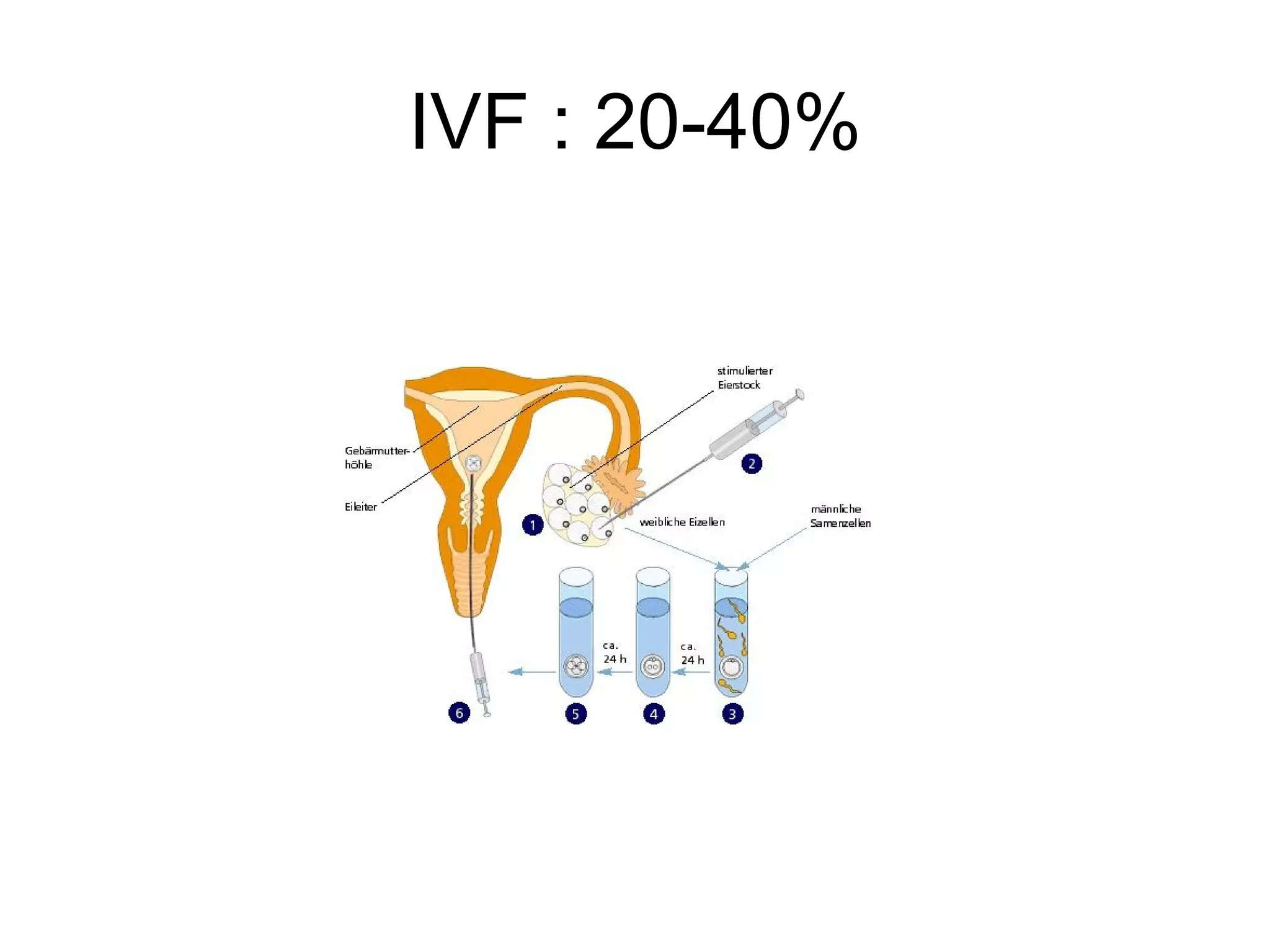 IVF : 20-40%
