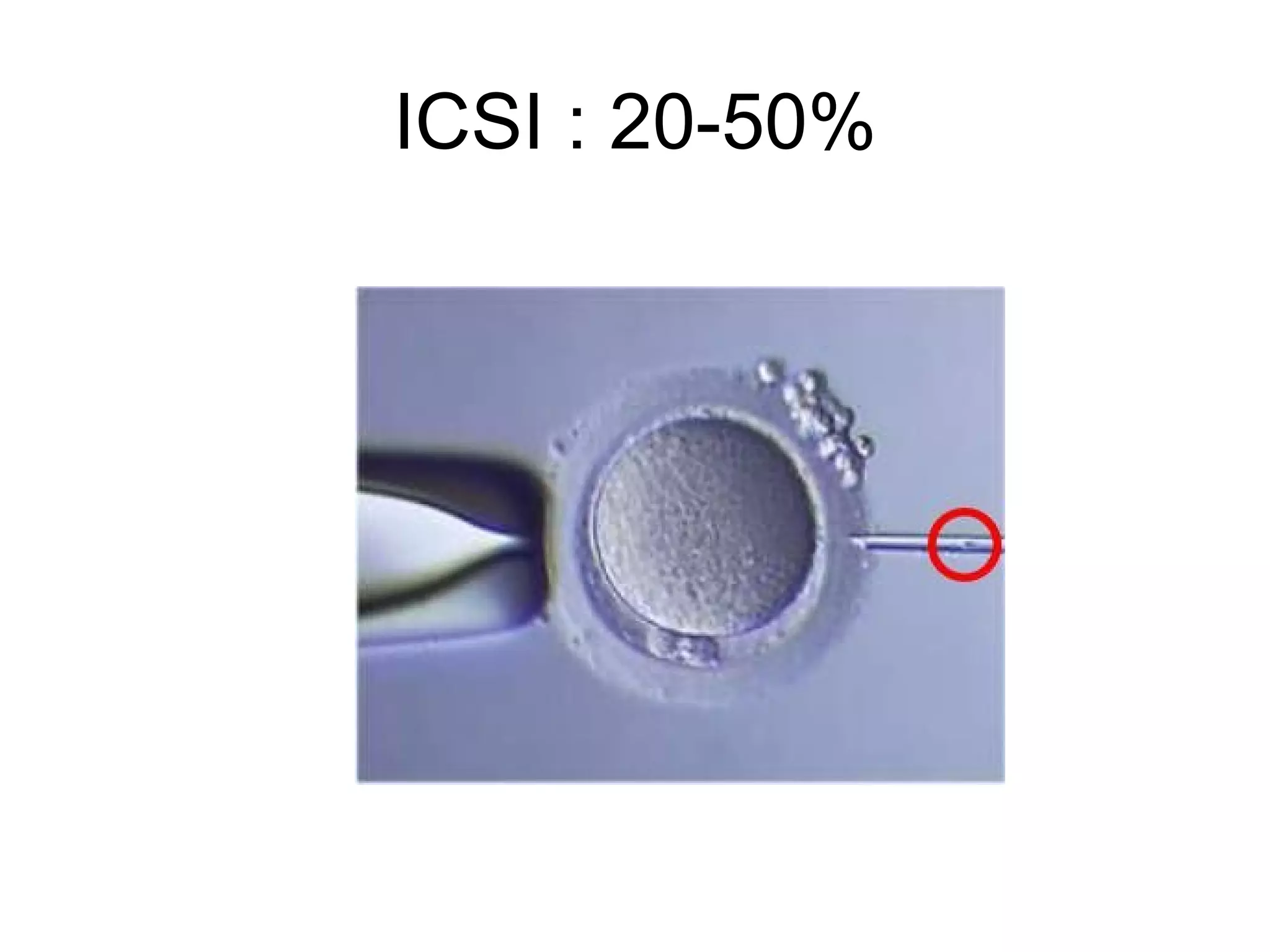 ICSI : 20-50%