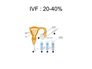 IVF : 20-40% 