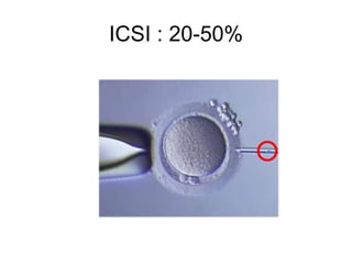 ICSI : 20-50% 