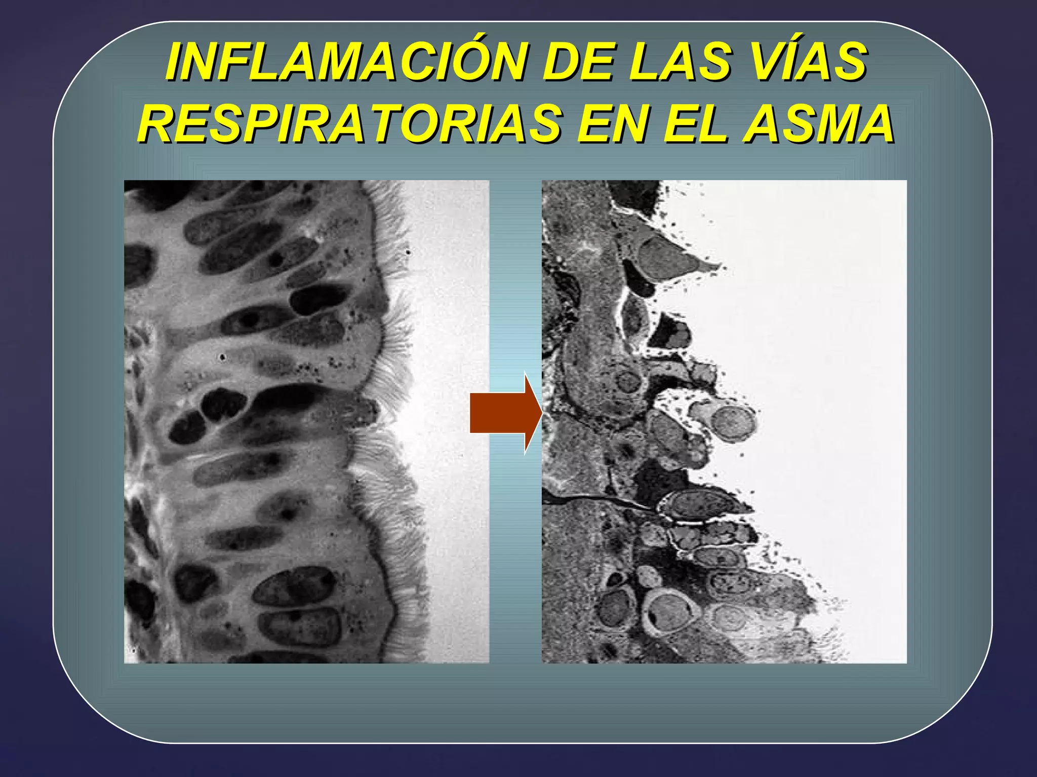 INFLAMACIÓN DE LAS VÍAS RESPIRATORIAS EN EL ASMA 