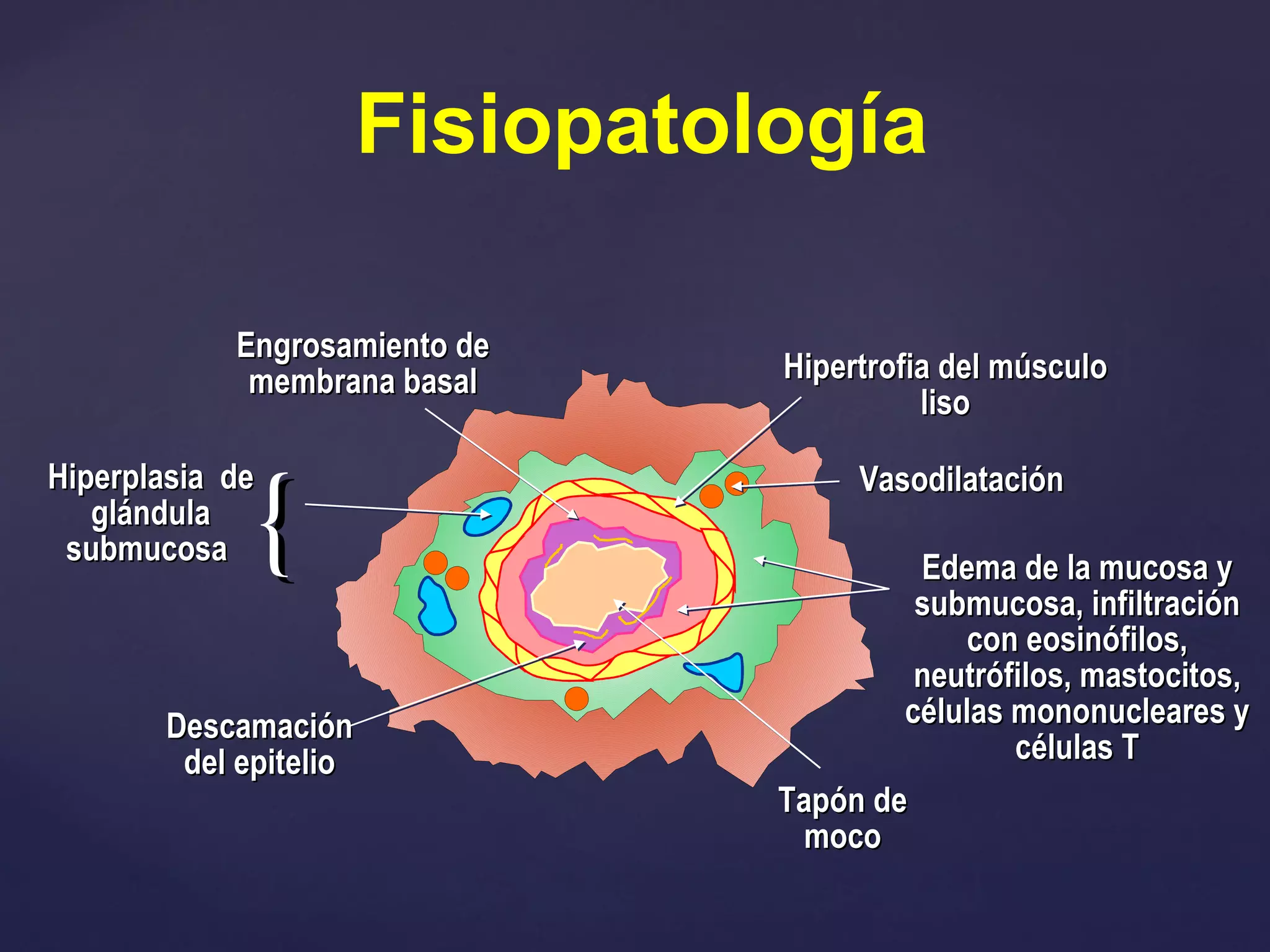 Fisiopatología Engrosamiento de membrana basal Hipertrofia del músculo liso Vasodilatación Tapón de moco Descamación del epitelio Hiperplasia  de glándula submucosa  Edema de la mucosa y submucosa, infiltración con eosinófilos, neutrófilos, mastocitos, células mononucleares y células T 